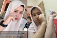 Iskurniawati, warga Desa Palengaan Laok, Kecamatan Palengaan menunjukkan luka lebam di kedua lengannya. (ISTIMEWA)