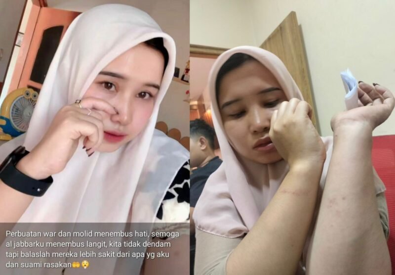 Iskurniawati, warga Desa Palengaan Laok, Kecamatan Palengaan menunjukkan luka lebam di kedua lengannya. (ISTIMEWA)